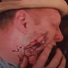 Ein Mann trägt einen Hut und hat eine schwere Verletzung im Gesicht, die blutig und offen wirkt.