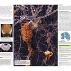 VERGESSLICHKEIT, PARKINSON-ERKRANKUNG, DEMENZ, ALZHEIMER-ERKRANKUNG. Illustration von neuronalen Plaques im Gehirn.