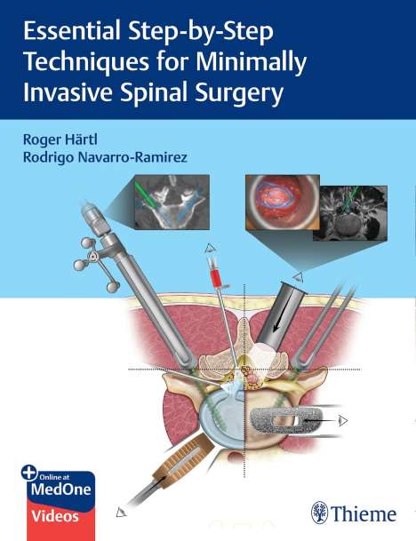 Roger Hartl: Essential Step-by-Step Techniques for Minimally Invasive Spinal Surgery, Buch
