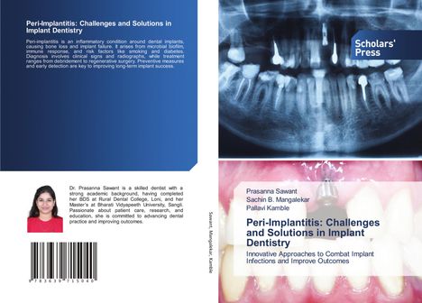 Prasanna Sawant: Peri-Implantitis: Challenges and Solutions in Implant Dentistry, Buch